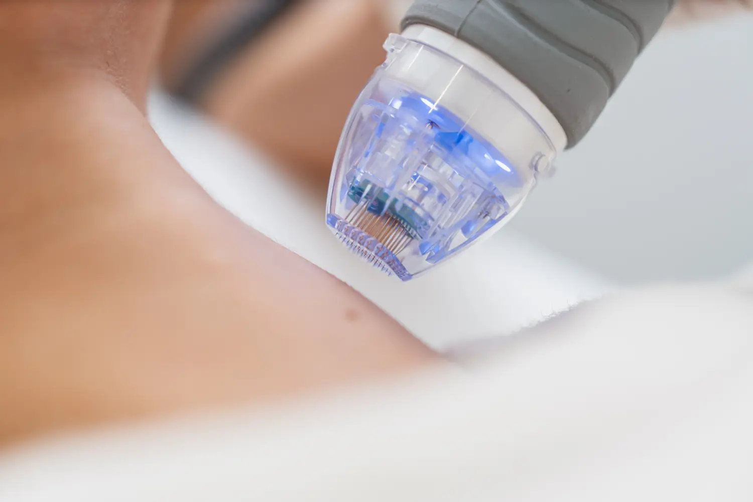 Microneedling Nentershausen